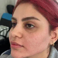 جشنواره تزریق ژل و بوتاکس|خدمات آرایشگری و زیبایی|اصفهان, دانشگاه اصفهان|دیوار