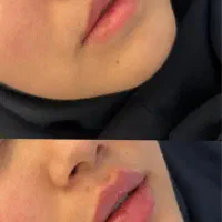 فیلر لب