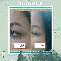 لیزر خال و زیگیل و لک بانوان