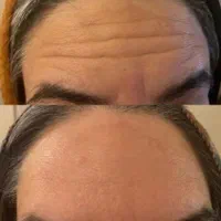 ژل بوتاکس فیلر پی ارپی مزوتراپی خال زگیل کک ومک|خدمات آرایشگری و زیبایی|شیراز, رحمت‌آباد|دیوار