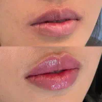 ژل،بوتاکس،لیزر،پاکسازی پوست،پی ارپی