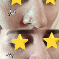 لیزر موهای زائدسوپرانو تیتانیوم وخالبرداری|خدمات آرایشگری و زیبایی|صدرا-فارس, فاز ۱|دیوار