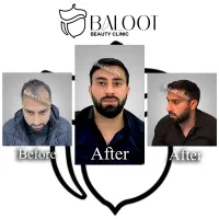 کاشت مو و ابرو با تخفیف ویژه و ضمانت کاشت