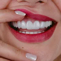 کامپوزیت ونیر لمینیت  عصب کشی ترمیم روکش ایمپلنت|خدمات آرایشگری و زیبایی|تهران, تهرانپارس شرقی|دیوار
