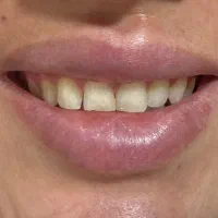 کامپوزیت 20تومن|خدمات آرایشگری و زیبایی|دورود, |دیوار