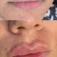 تزریق ژل و بوتاکس