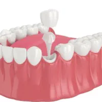 عصب‌کشی دندان، روکش و ترمیم با تعرفه دولتی