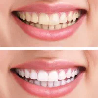 دندانپزشک قسطی بدون پیش پرداخت کلیه خدمات|خدمات آرایشگری و زیبایی|اصفهان, دشتستان|دیوار