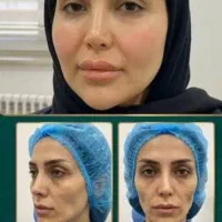 خدمات ژل وبوتاکس