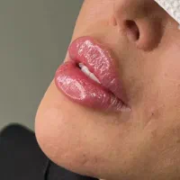 تزریق فیلر و بوتاکس در کلینیک پوست و لیزر سهرابی|خدمات آرایشگری و زیبایی|کرمانشاه, |دیوار