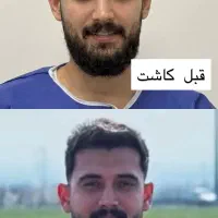 بازگشت جوانی با کاشت موی طبیعی در اردبیل