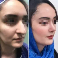 عمل بینی دکتر پلاس با سفته تضمینی