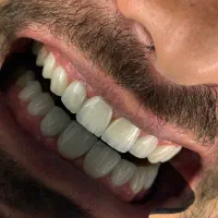 مدل کامپوزیت با تکنیک لیرینگ