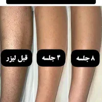 مجهزترین مرکز لیزر با دو دستگاه شاتی و رولی|خدمات آرایشگری و زیبایی|سبزوار, کاشفی شمالی (دادگستری)|دیوار