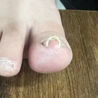 پدیکور مانیکور ناخن -ناخن فرورفته پاکسازی بدن