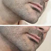 آف ویژه تزریق ژل و بوتاکس|خدمات آرایشگری و زیبایی|یاسوج, |دیوار