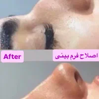 تزریق ژل وبوتاکس تخفیف ویژه|خدمات آرایشگری و زیبایی|تهران, خانی آباد نو شمالی|دیوار