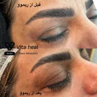 جشنواره یلدایی ریموو تخصصی تتو ابرو چشم و لب