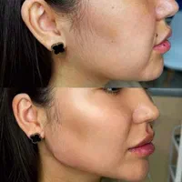 خدمات ژل و بوتاکس ، مزوتراپی سر و صورت|خدمات آرایشگری و زیبایی|شاهینشهر, فردوسی|دیوار