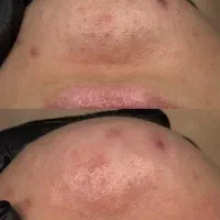 رفع جای جوش و چین وچروک