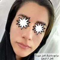 ژل وبوتاکس بلک فرایدی404(اقساط)(توسط پزشک)|خدمات آرایشگری و زیبایی|خرمآباد, |دیوار