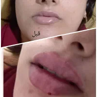 تزریق ژل و بوتاکس ماندگاری بالا مخصوص خانمها