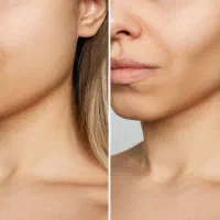 بلفاروپلاستی،بوکال فت،لیفت سانترال لب،لیپوست غبغب|خدمات آرایشگری و زیبایی|گرگان, |دیوار