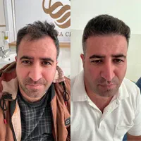 جشنواره کاشت مو
