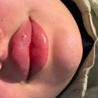 ژل و بوتاکس و مزو ژل|خدمات آرایشگری و زیبایی|بومهن, |دیوار