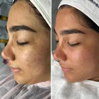 ٪۳۰ تخفیف فشیال و پاکسازی پوست و صورت در کلینیک|خدمات آرایشگری و زیبایی|قم, پردیسان|دیوار