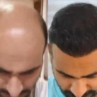 کاشت مو و ابروی طبیعی مزو و پی آرپی جلوگیری ریش مو|خدمات آرایشگری و زیبایی|تبریز, |دیوار