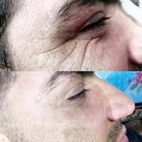 تزریق ژل و بوتاکس فقط ۵۰۰هزارتومان|خدمات آرایشگری و زیبایی|فولادشهر, B2|دیوار