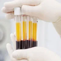 نمونه گیری و آماده سازی پلاکت برای PRP