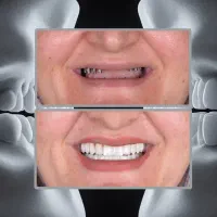 جشنواره یلدایی ایمپلنت دیجیتال/۴واحد ۱ واحد رایگان|خدمات آرایشگری و زیبایی|تهران, هروی|دیوار