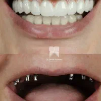 ثبت نام بیمه دندانپزشکی و کامپوزیت طلایی شو|خدمات آرایشگری و زیبایی|گرگان, |دیوار