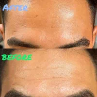 بوتاکس توسط پزشک جهت رفع چین و چروک و لیفت ابرو|خدمات آرایشگری و زیبایی|یزد, |دیوار