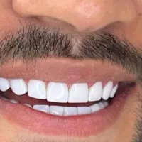 جشنواره کامپوزیت 8000 م ،عصب کشی از۲۵۰۰ توسط پزشک|خدمات آرایشگری و زیبایی|رشت, دروازه لاکان|دیوار