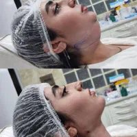 پزشک جراحی بلفا غبغب نخ لیفت کلاژن آنزیم ژل فیلر|خدمات آرایشگری و زیبایی|کرج, گوهردشت|دیوار