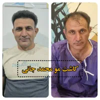 کاشت مو ،ابرو و ریش در شیراز|خدمات آرایشگری و زیبایی|کازرون, |دیوار