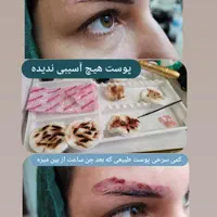 ریمووپاک کردن تتوتاتوابروصورت بدن|خدمات آرایشگری و زیبایی|رشت, فلسطین|دیوار