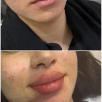 تزریق ژل وبوتاکس برای مدل|خدمات آرایشگری و زیبایی|اهواز, پردیس دو|دیوار