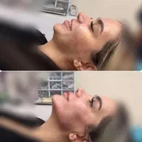 ژل بوتاکس فیلر چشم زاویه فک گونه چانه فشیال بیکینی|خدمات آرایشگری و زیبایی|قم, زنبیل آباد|دیوار