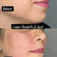 تزریق ژل و بوتاکس، لیزر موهای زائد، لاغری تضمینی|خدمات آرایشگری و زیبایی|رشت, دیلمان|دیوار