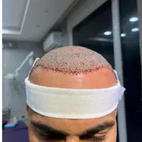 کاشت مو ، ریش ، ابرو
