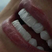 کامپوزیت.لمینت|خدمات آرایشگری و زیبایی|تهران, هفت حوض|دیوار