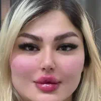 تزریق ژل وفیلربادی بوتاکس