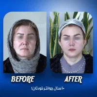 مکس لیفت/جوانسازی طبیعی/لیفت صورت/عمل بینی/بلفارو