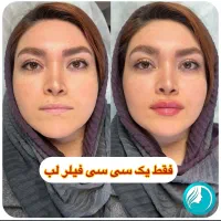 تخفیفات ۵۵٪ دکتر ملائی ،مزو بوتاکس فیلر ژل لب روسی|خدمات آرایشگری و زیبایی|مشهد, سرافرازان|دیوار