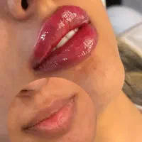 جشنواره تخفیف ۴۰ درصدی بوتاکس وفیلرو ژل