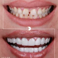 کامپوزیت/لمینت/دندانپزشکی|خدمات آرایشگری و زیبایی|مشهد, کوثر|دیوار